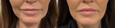 Kybella before and after photo