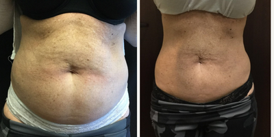 CoolSculpting before and after photo