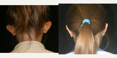 Ear Surgery before and after photo
