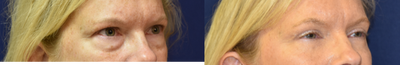 Eyelid Surgery before and after photo