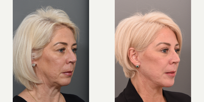 Laser Resurfacing before and after photo