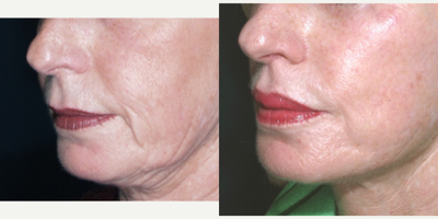 Lip Fillers before and after photo