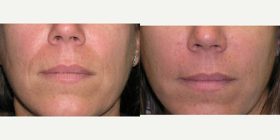 Restylane before and after photo