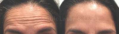 Botox before and after photo