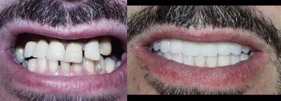 Dental Implants before and after photo