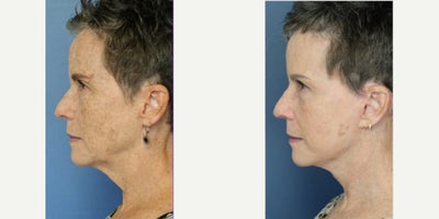 Facelift before and after photo