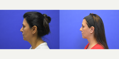 FaceTite before and after photo