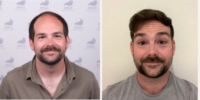 Hair Transplant before and after photo