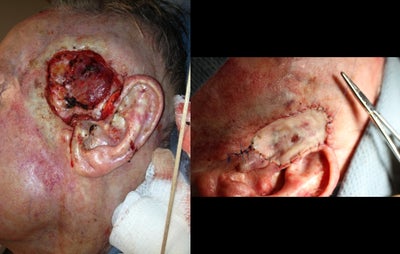 Mohs Surgery before and after photo