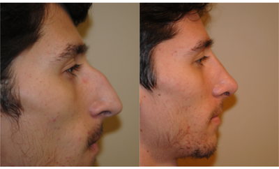 Rhinoplasty before and after photo