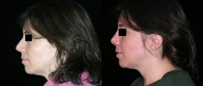 Rhinoplasty before and after photo