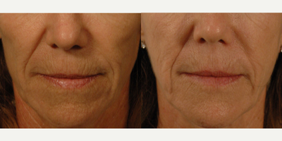 Sculptra before and after photo