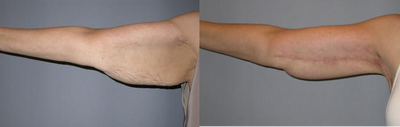 Arm Lift before and after photo