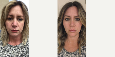 Microneedling before and after photo
