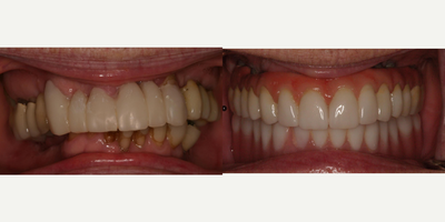 Porcelain Veneers before and after photo
