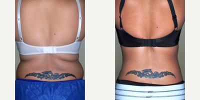 Vaser Liposuction before and after photo
