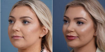 Buccal Fat Removal before and after photo