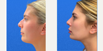 Dermal Fillers before and after photo