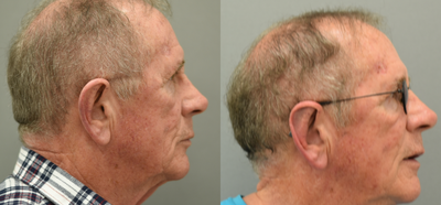 Ear Surgery before and after photo