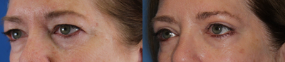Eyelid Surgery before and after photo