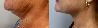 Kybella before and after photo
