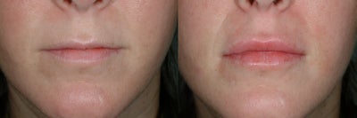 Lip Fillers before and after photo