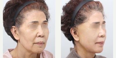 Neck Lift before and after photo