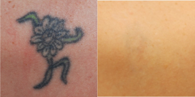 Tattoo Removal before and after photo