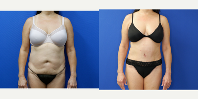Tummy Tuck before and after photo