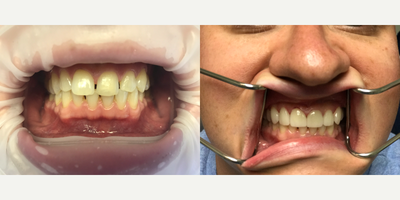 Dental Bonding before and after photo