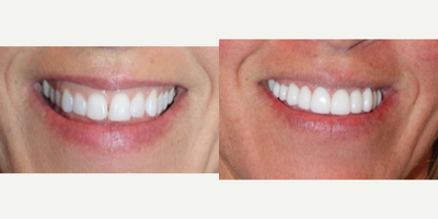 Gum Lift before and after photo