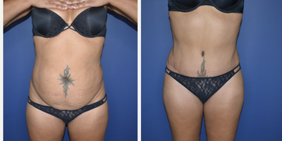 Liposuction before and after photo