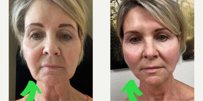 Nonsurgical Facelift before and after photo