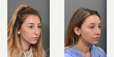 Rhinoplasty before and after photo