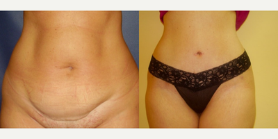 Tummy Tuck before and after photo