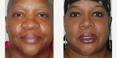 African American Rhinoplasty before and after photo