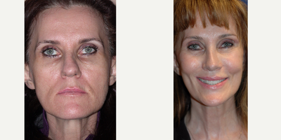 Facelift before and after photo
