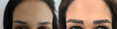 FUE Hair Transplant before and after photo