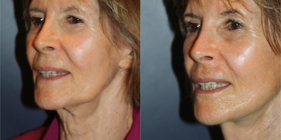 Neck Lift before and after photo