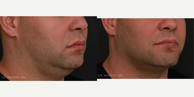 Revanesse before and after photo