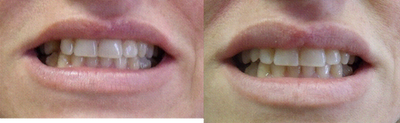 Dental Implants before and after photo
