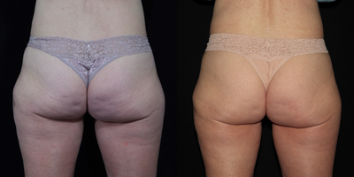 Emsculpt before and after photo