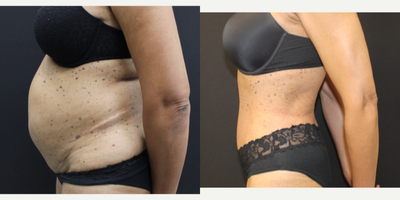 Liposuction before and after photo