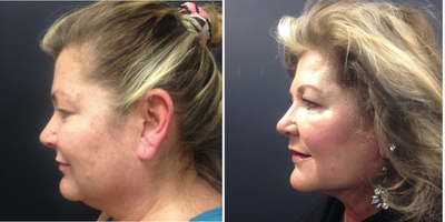 Nonsurgical Neck Lift before and after photo