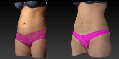 Smart Lipo before and after photo