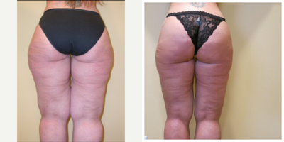 Butt Augmentation before and after photo