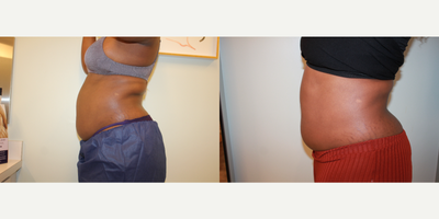 CoolSculpting before and after photo