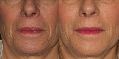Dermal Fillers before and after photo