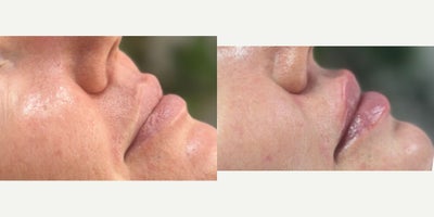 Lip Fillers before and after photo