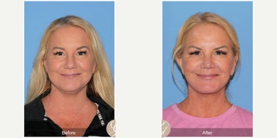 Rhinoplasty before and after photo